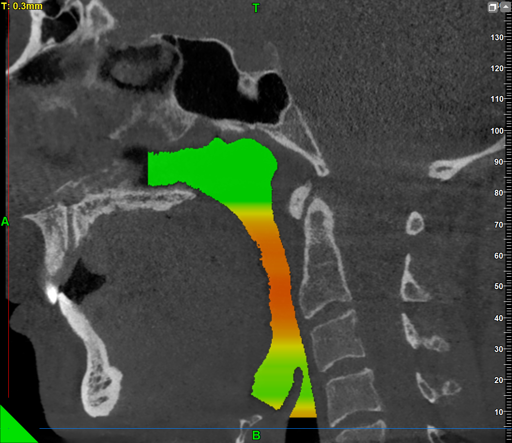 What Really Causes Obstructive Sleep Apnea?